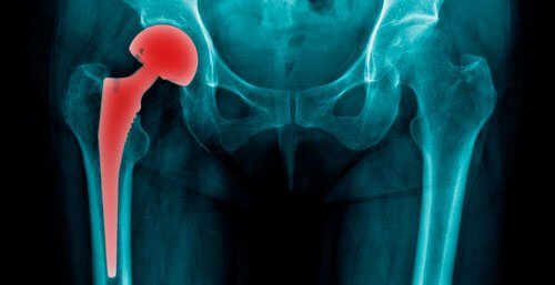 Hip Replacement Product Recalls Are On the Rise